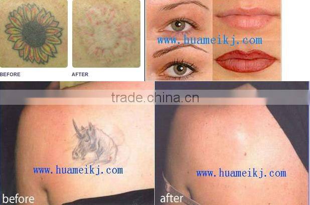 weifang huamei q switch nd yag /nd yag tattoo removal machine /nd yag laser