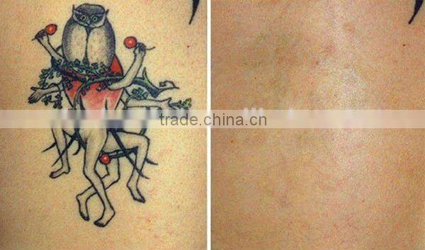 Y7 brow tattoo removal ND yag laser equipment