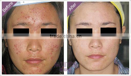 Factory selling! high quality 540 titanium micro needle machine best for hair loss treatment/dns skin care derma roller