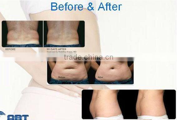 2015 best seller ultrasonic lipo cavitation slimming machine