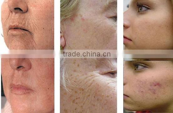 2015 Hot IPL Elight SHR Three in One Permanent Hair Removal Machine With CE Approved for Skin Rejuvenation and Hair Removal