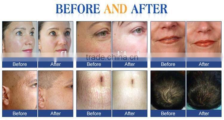Derma roller for stretch marks