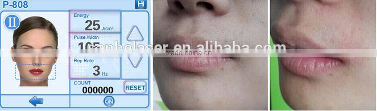 2016 Newest model Germany bars portable 808nm diode laser for laser hair removal!