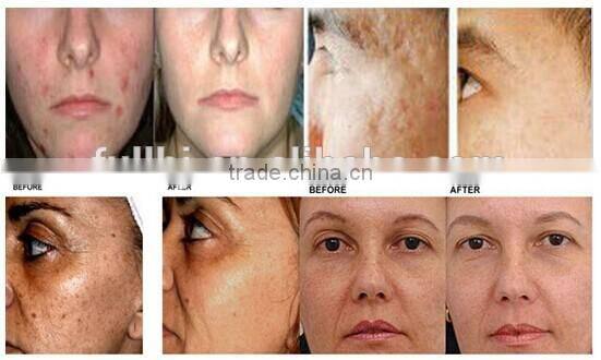 anti aging women wrinkle removal Er YAG 2940 Fractional laser machine