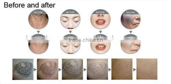 Muti-Function Beauty Equipment IPL SHR Laser