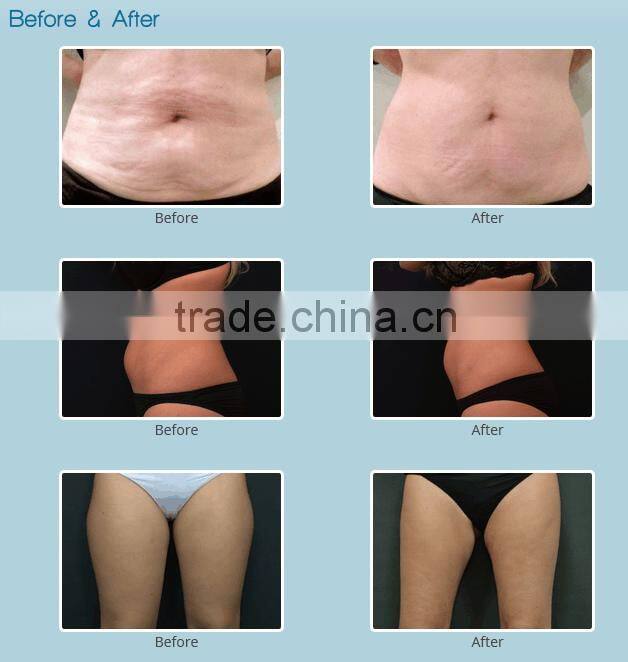 Desktop cold laser 650nm mini laser sculpting slimming device BS-18b