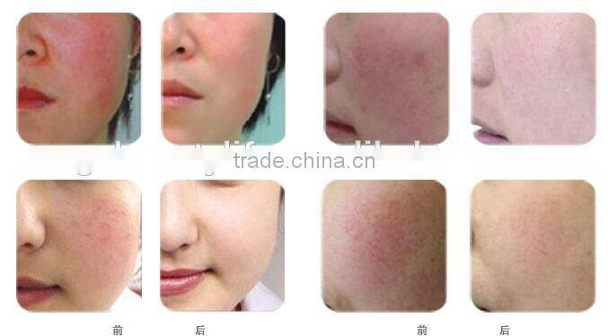 Spider Veins Laser Red Blood Vessels Removal Machine