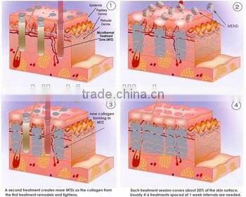 2015 Hot sale !!! Best effective Beauty Equipment fractional co2 laser with CE Certification