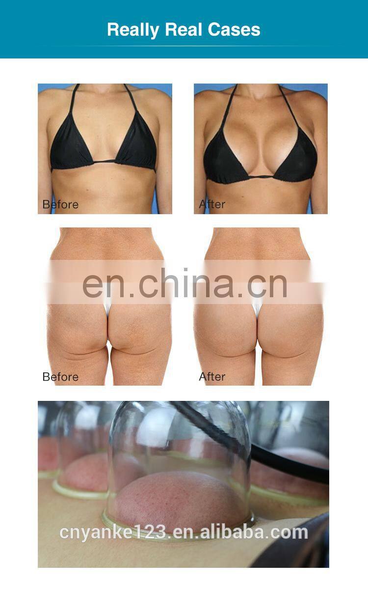 Powerful Women vacuum suction cup therapy vacuum butt lifting machine / breast enhancement buttocks enlargement machine