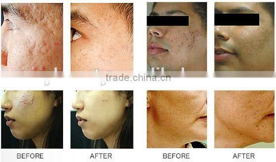 AYJ-G028C 2016 water dermabrasion crystal microdermabrasion spa face cleaning machine