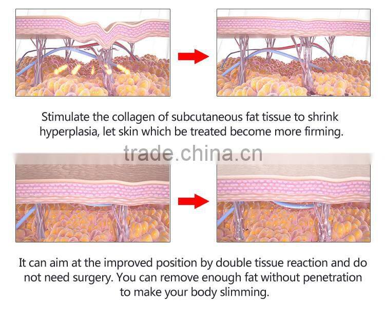 The Hifu High Intensity Focused Ultrasound Machine For Body Slimming