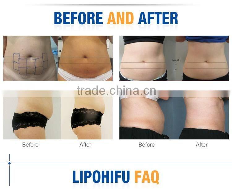 Newest Technology Loss Weight Lipo Fat Loss / Lipohifu Machine / Liposonic Slimming Machine