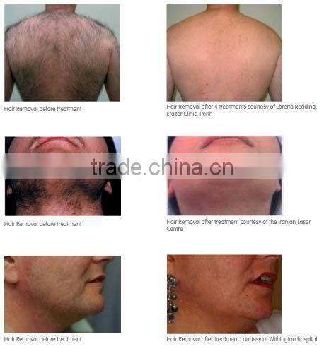 2016 Hot table Set 808 Diode Laser hair removal machine