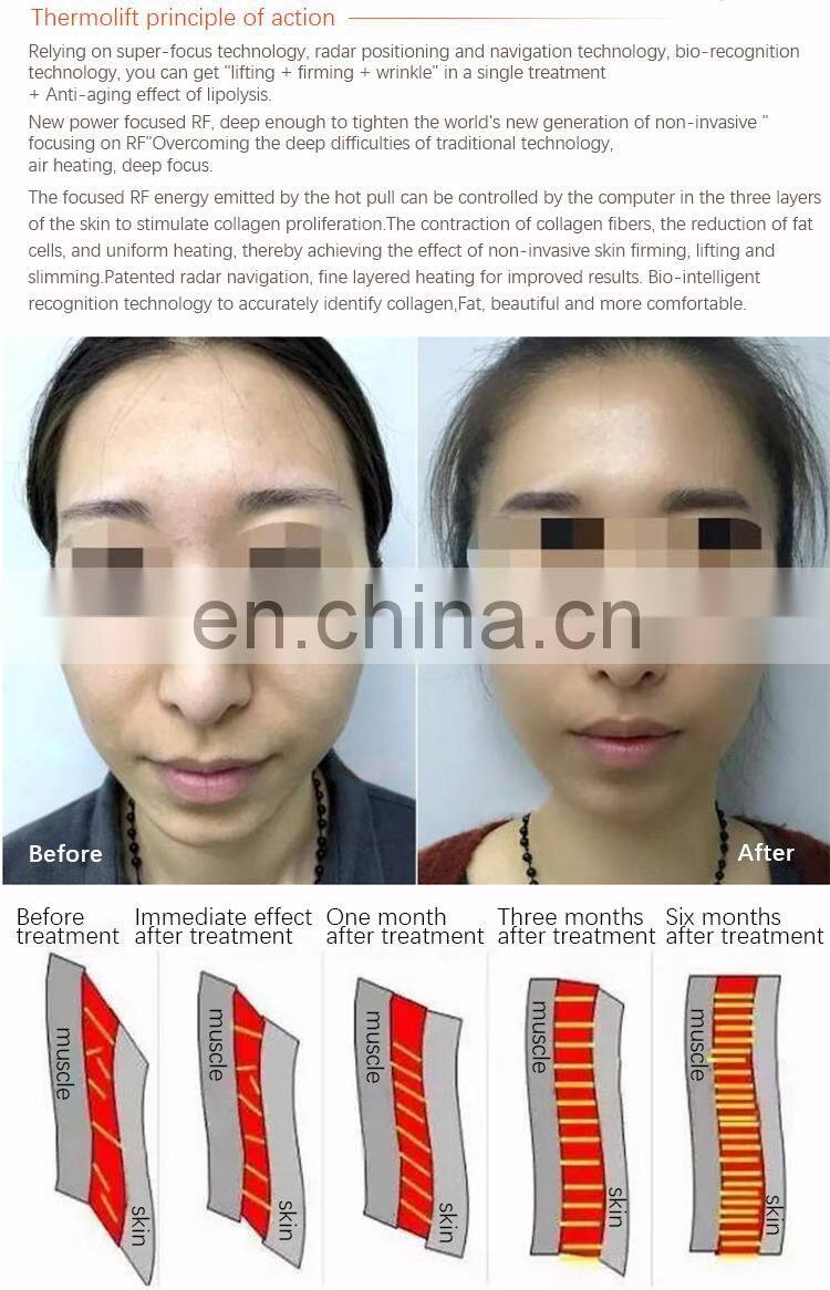 Thermolift monopolar RF skin tightening machine