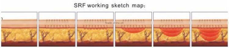 Beir portable Thermacool beauty equipment/ Thermacool RF skin rejuvenation beauty instrument