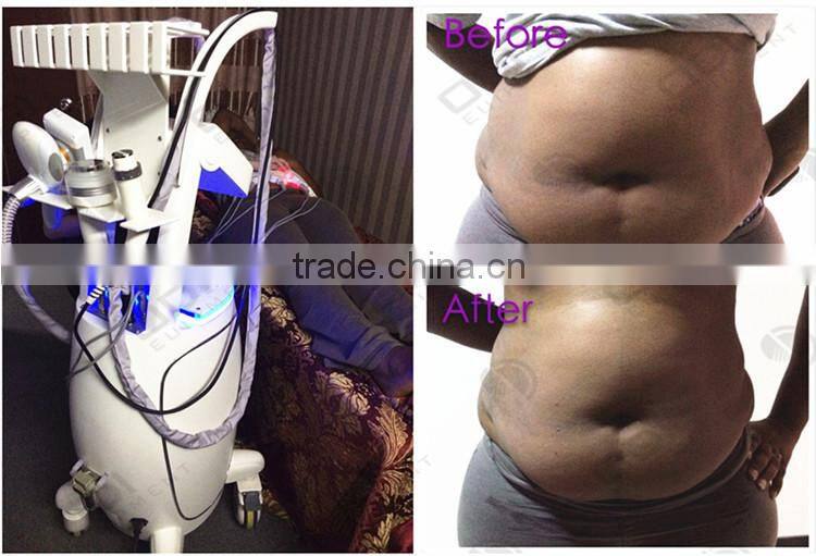 4 in 1 tripolar rf slimming equipment using ultrasound gel OD-S10