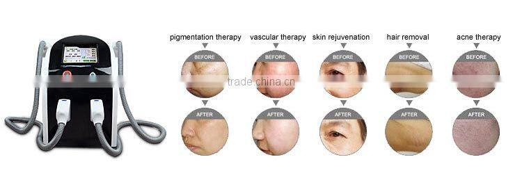 Best quality hot selling factory supply (Magicbelle)!!! professional SHR machine/OPT beauty equipment for hair removal