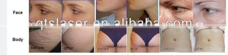 Cavitation RF vacuum beauty machine with LED skin tightening