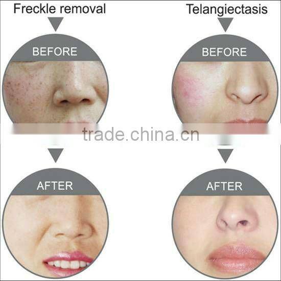 Multifunctional popular ipl elight depilation hair removal