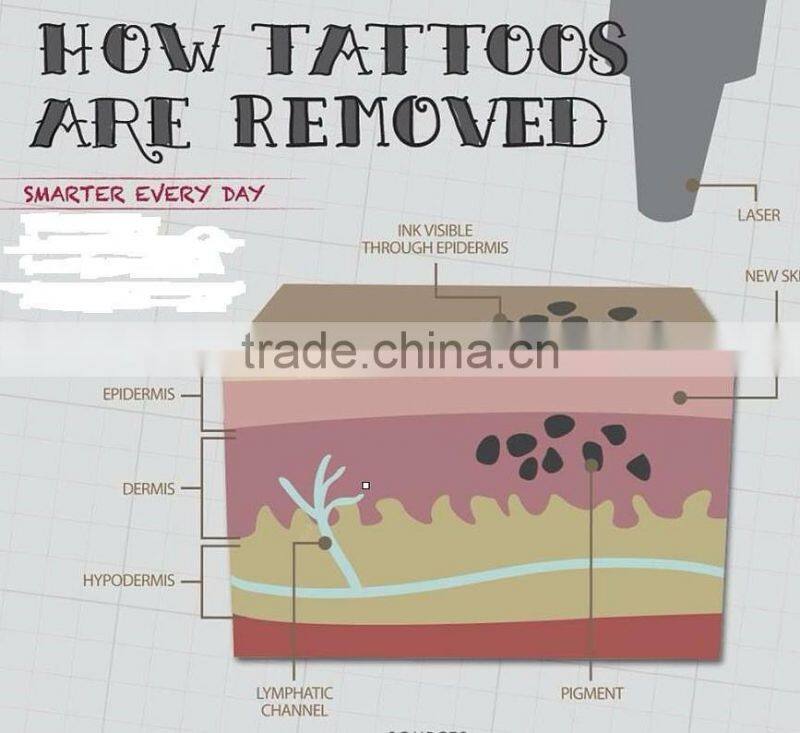 2016 Portable nd yag laser tattoo removal machine /laser tattoo removal equipment for spa/clinic/hospital