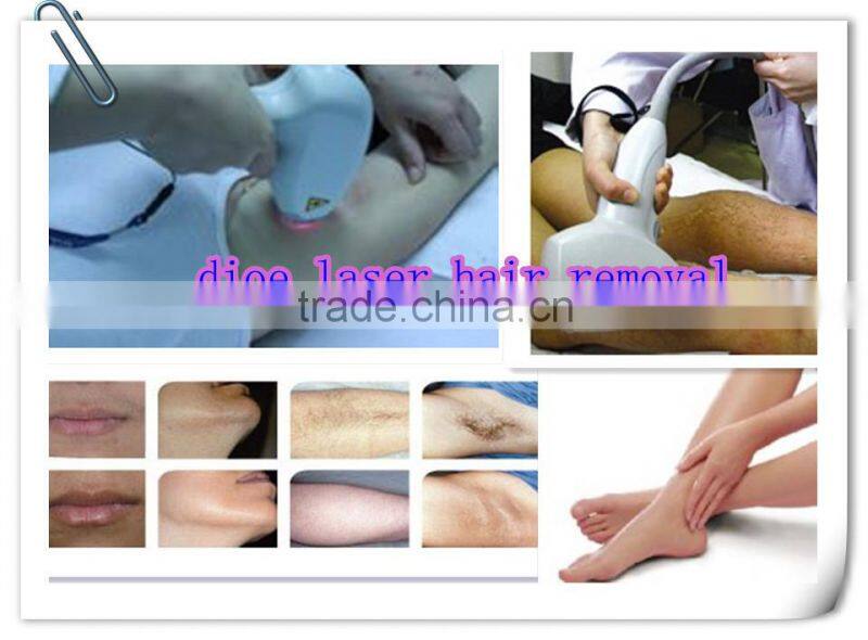 Painless 808nm diode laser hair removal