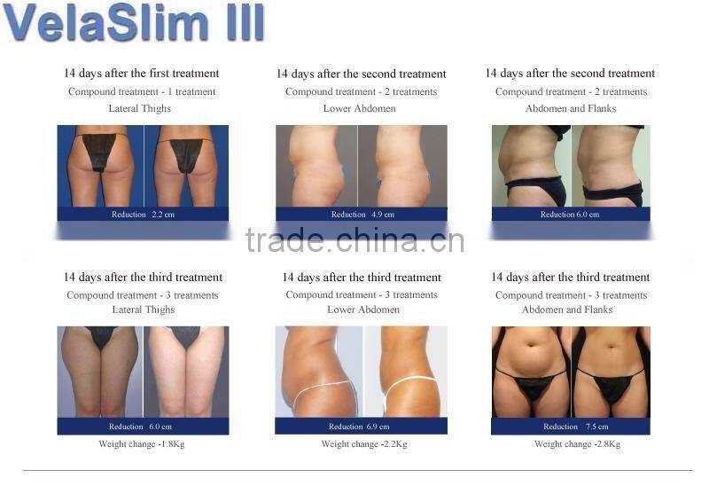 Distributors Wanted VelaSlim vacuum massage machine for liposuction