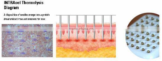 Personal care and beauty series product fractional rf skin lifting machine