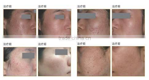 ultrapulse fractional co2 laser