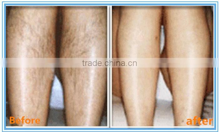 best prices long quality warranty 1064nm long pulse nd yag laser hair removal machine