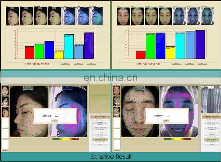 Multi Function light facial skin analysis machine for Skin Sensitiveness And Age Test
