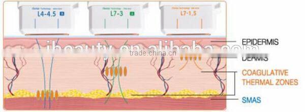 2015 Focused ultrasound fat reduce Hifu slimming system