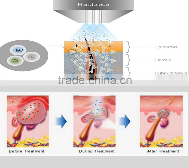 Water Oxygen Jet machine for Sun-damaged skin treatment