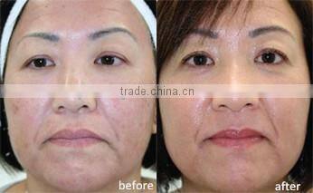 CET&RET RF face lifting multifunction rf