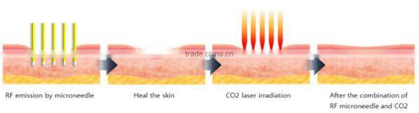 2015 popular most powerful! anti-wrinkle microneedles fractional rf micro needles machine