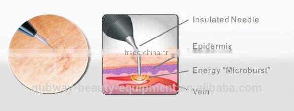 Professional painless spider vein removal for removal soften blood vessels