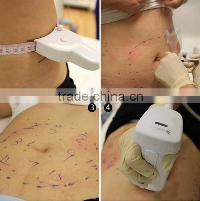 weight loss hifu ultrasound korea slimming machine FU-18S