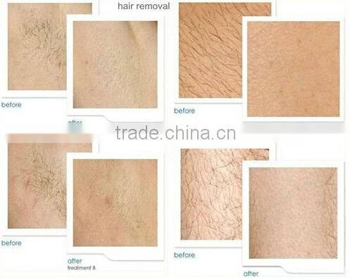 Diode laser 808 nm machine for personal care & hair removal & face liftup beauty equipment