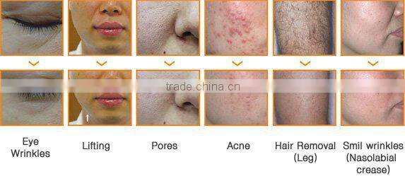 2016 new ipl hair removal &skin rejuvenation beauty machine for IPL beauty salon use