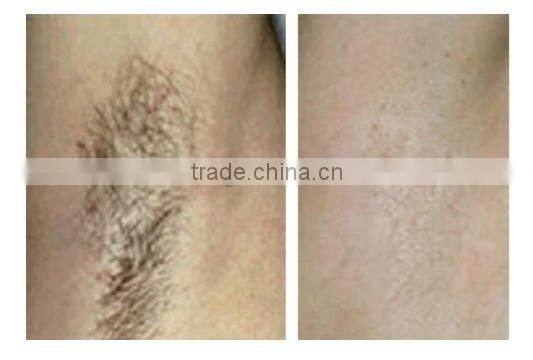 Portable IPL Underarm Hair Removal Machine-A005