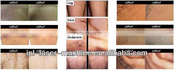 spa use portable ipl skin rejuvenation mini home hair removal ipl 2014