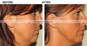 Facial care winkle removal RF beauty machine for salon