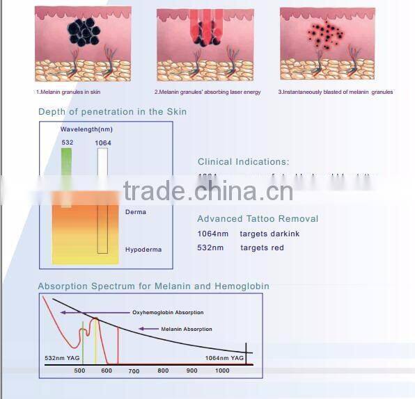 Q-switch 1000W big spot Nd Yag Laser for tattoo pigment remaoval FDA approved