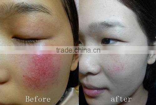 wholesale 980nm laser vascular removal diode laser