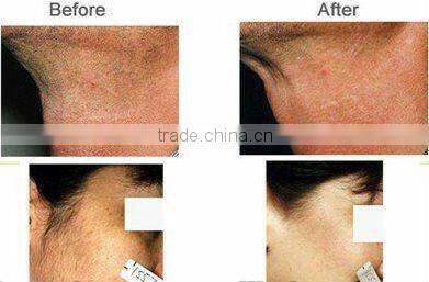 antiwrinkle Radio Frequency Machine for skin tightening