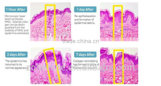 Small Mini Cryo slim freezer weight loss belt BD02