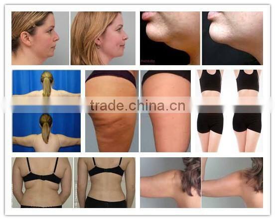 Good result slimming products coolsculption thighs before and after