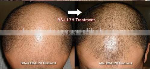 2015 hot sale! PDT laser led hair regrowth machine (CE approval) BS-LL7H