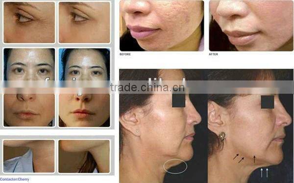 VY-QF8 Popular radio frequency facial machine for skin tightening