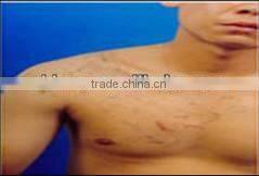 1064nm&532nm Q-switch Nd:YAG laser machine