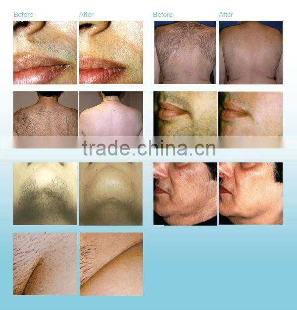 mobile laser hair removal machine suit for all skin types beauty salon equipment with CE P003